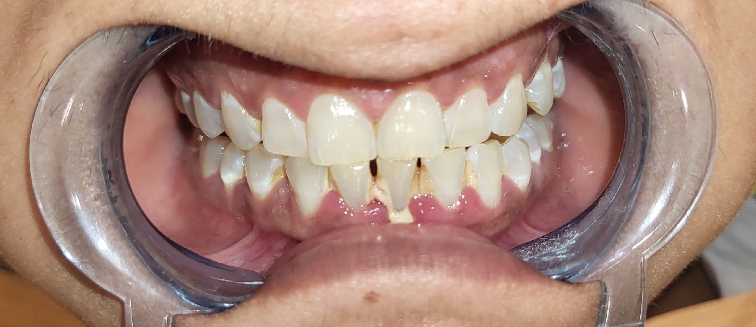 Crowded and misaligned front teeth After.jpg scaled