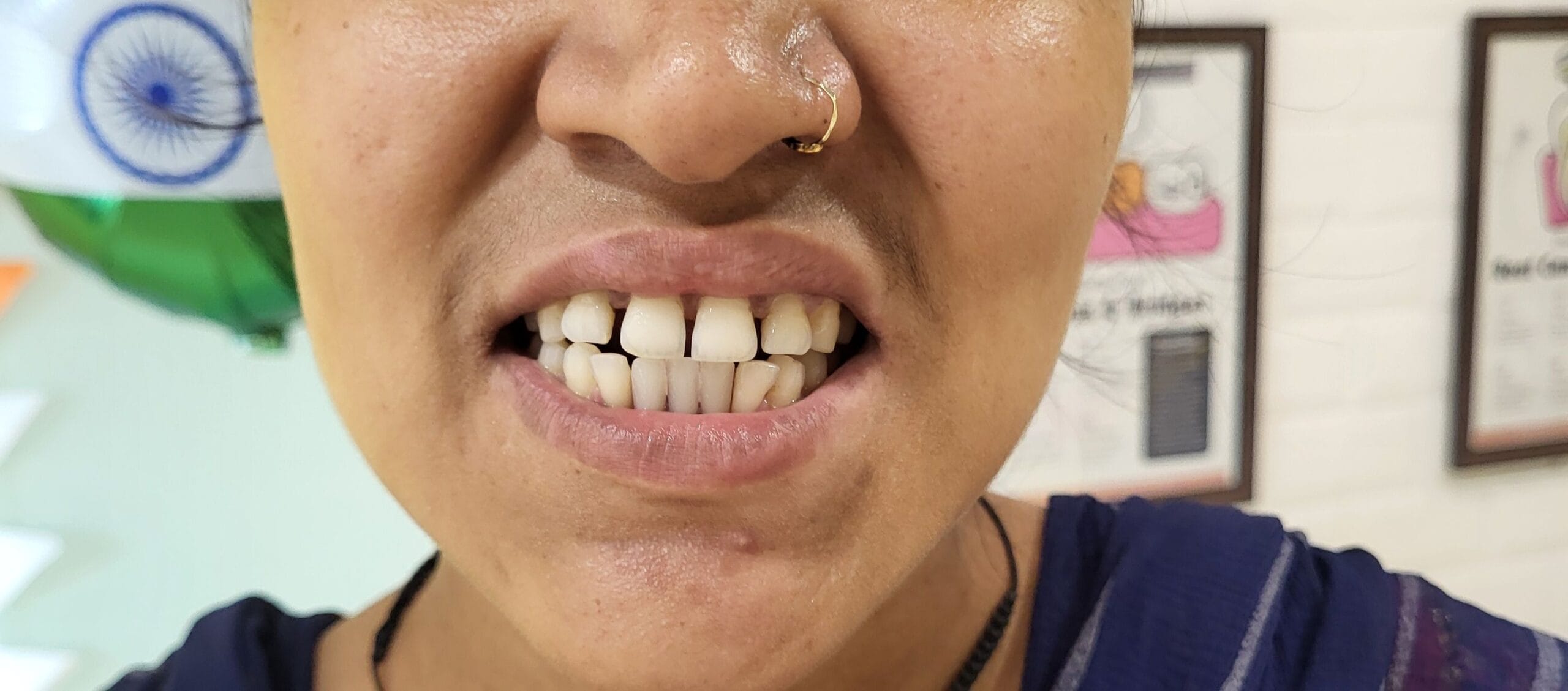 Fix Missing Tooth After.jpg scaled