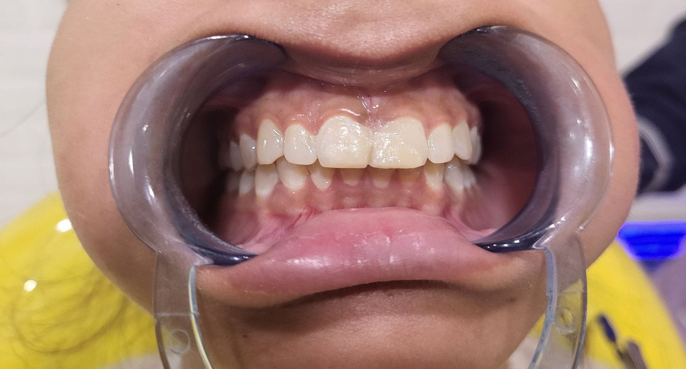 midline diastema after